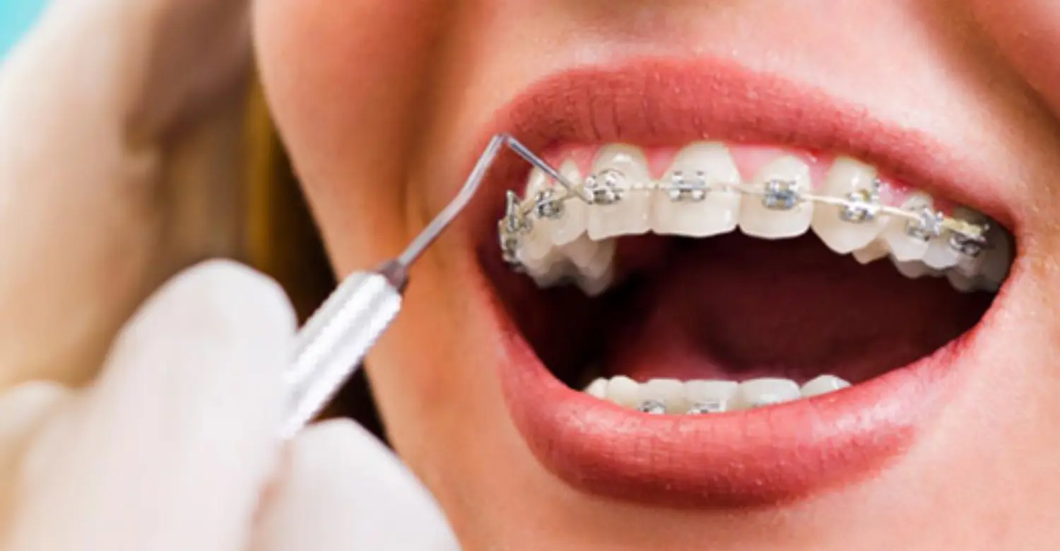 Accelerated orthodontics 2